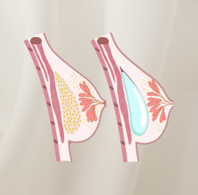 Breast Implants Vs Fat Transfer