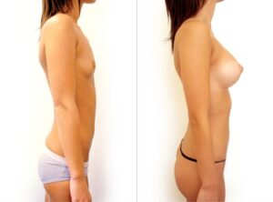 Breast augmentation mammoplasty, before and after 1, Dr Rastogi Sydney