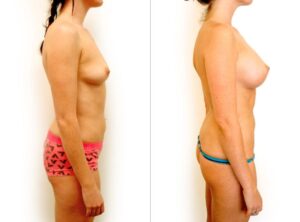 Breast implants surgery results 2, Dr Rastogi Plastic Surgery Clinic Double Bay, Sydney