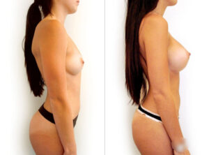 Breast augmentation before and after 3, Dr Rastogi Sydney