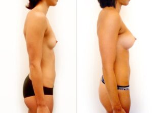 Before and after breast augmentation 4, Dr Rastogi, Double Bay, Sydney