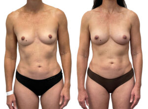 Breast fat transfer, Breast augmentation before and after 1-1, front view, Dr Rastogi, Double Bay