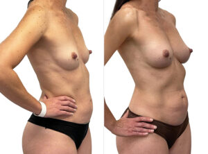 Patient before and after breast augmentation surgery (breast fat transfer) 1-7, angle view