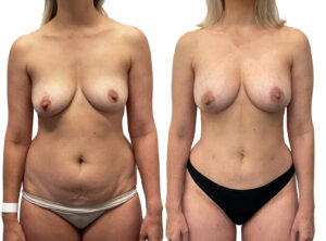 Breast augmentation before and after 2-2, Dr Rastogi Sydney