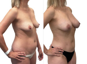 Breast augmentation results (before and after) 2-3, Dr Rastogi, Sydney, Double Bay