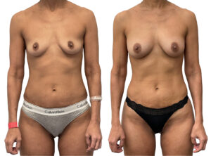 Dr Rastogi, breast augmentation before and after 4-1, front view
