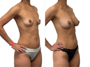 Breast augmentation BA 4-5, angle view, Dr Rastogi