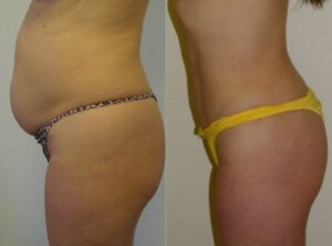 Liposuction before and afer 10, Rastogi Clinic Sydney