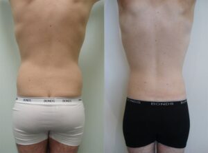 Male liposculpture (liposuction), before and after 02, Dr Rastogi Sydney