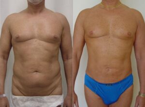 Male liposuction before and after 06, Dr Rastogi Sydney
