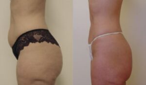 Mini abdominoplasty, before and after 1-1, Dr Rastogi Sydney