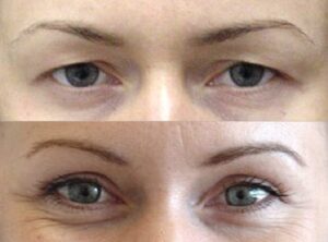 Eyelid surgery (Blepharoplasty) before and after 01, Dr Rastogi Sydney & Double Bay