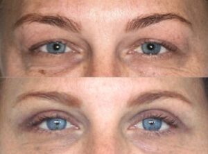 Dr Rastogi patient before and after upper eyelid surgery 02