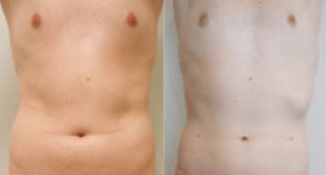 Male stomach liposuction, before and after 1, front view, Dr Rastogi