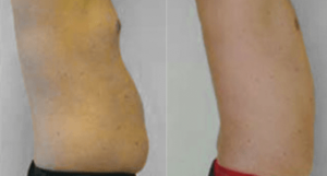 Male abdominal liposuction, before and after 2, side view, Dr Rastogi
