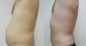 Male stomach liposuction, before and after 3, side view, Dr Rastogi