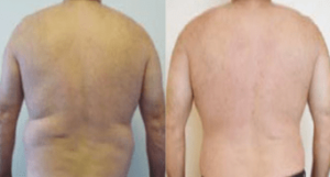 Male liposuction, before and after 4, back view, Dr Rastogi
