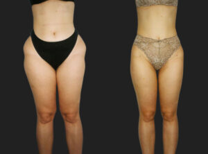 Female liposcution (tummy & thighs), before and after 7-1, Dr Rastogi Double Bay
