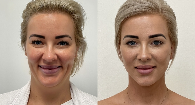 large-facelift-img