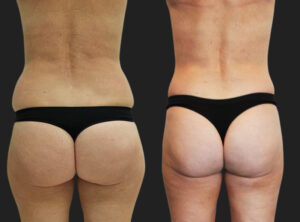 Buttocks lift with liposuction results 9-1, Dr Rastogi