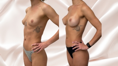 Breast augmentation surgery before and after v2, Dr Rastogi Double Bay, Sydney