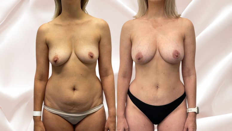 Breast fat transfer surgery before and after @2x, Dr Rastogi Double Bay, Sydney