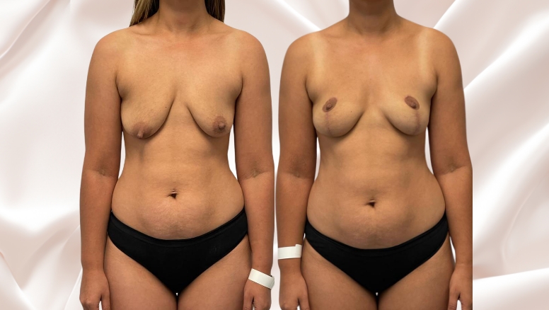 Breast lift surgery before and after @2x, Dr Rastogi Double Bay, Sydney