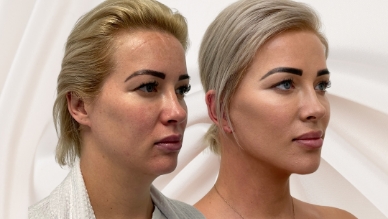 Facelift before and after, Dr Rastogi Double Bay, Sydney