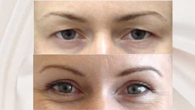 Upper blepharoplasty befroe and after, Dr Rastogi Double Bay, Sydney