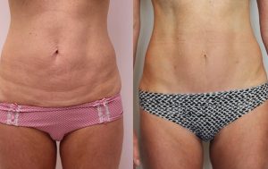 Patient before and after mini abdominoplasty 03, Dr Rastogi Double bay, Sydney