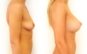 Breast implants, patient before and after surgery 09-2, right side view