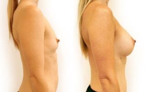 Breast implants surger patient before and after procedure 06-2