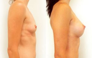 Patient before and after breast augmentation with implants 07-2, Dr Rastogi Double Bay Sydney