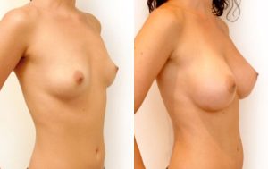 Breast augmentation Sydney, before and after 01-2, Dr Rastogi