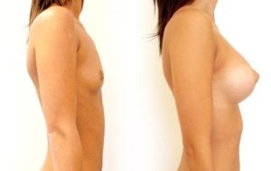 Breast augmentation surgery, before and after 04-2, Dr Rastogi Double Bay Sydney