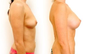 Breast augmentation with implants, before and after 03-2, Dr Rastogi, right side view