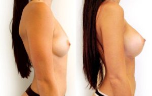 Breasrt implants surgery before and after 05-2, Dr Rastogi Sydney