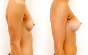 Breast implants surgery, before and after 02-2, Dr Rastogi Double Bay, Sydney