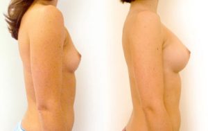 Breast augmentation before and after 5@4x, side view, Dr Rastogi Double Bay, Sydney