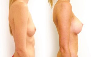 Breast implants results, 12-2, Dr Rastogi Sydney