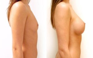 Breast augmentation before and after 10-2, Dr Rastogi