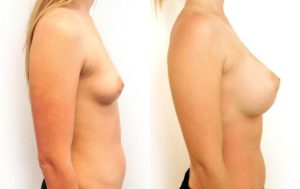 Breast augmentation results 11-2 (before and after), Dr Rastogi