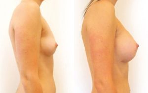 Breast augmentation surgery, before and after 08-2, Dr Rastogi