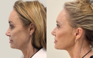Face lift before and after 1@4x, side view, Dr Rastogi Cosmetic & Plastic Surgery, Sydney