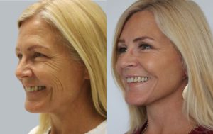 Facelift before and after 2@4x, surgery results, angle view, Dr Rastogi Double Bay