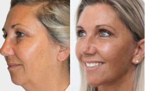 Face reshaping surgery (facelift), before and after 3@4x, Dr Rastogi