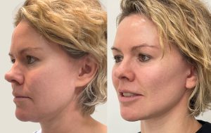 Facelift surgery, before and afters 4@4x, angle view, Dr Rastogi Cosmetic Surgery