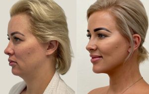 Facelift before and after 5@4x, angle view, Dr Rastogi