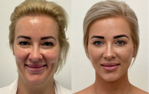 Facelift before and after 6@4x, front view, Dr Rastogi, Double Bay, Sydney
