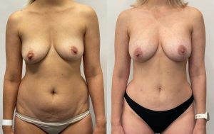Patient before and after fat trasfer to breast 2-2, Dr Rastogi